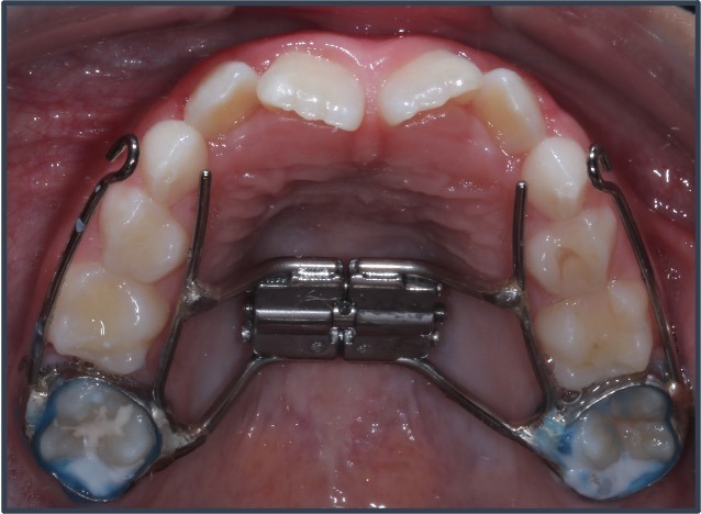 Palatal expander device in a child's mouth, designed to widen the upper jaw and improve airway space for better breathing and dental alignment.