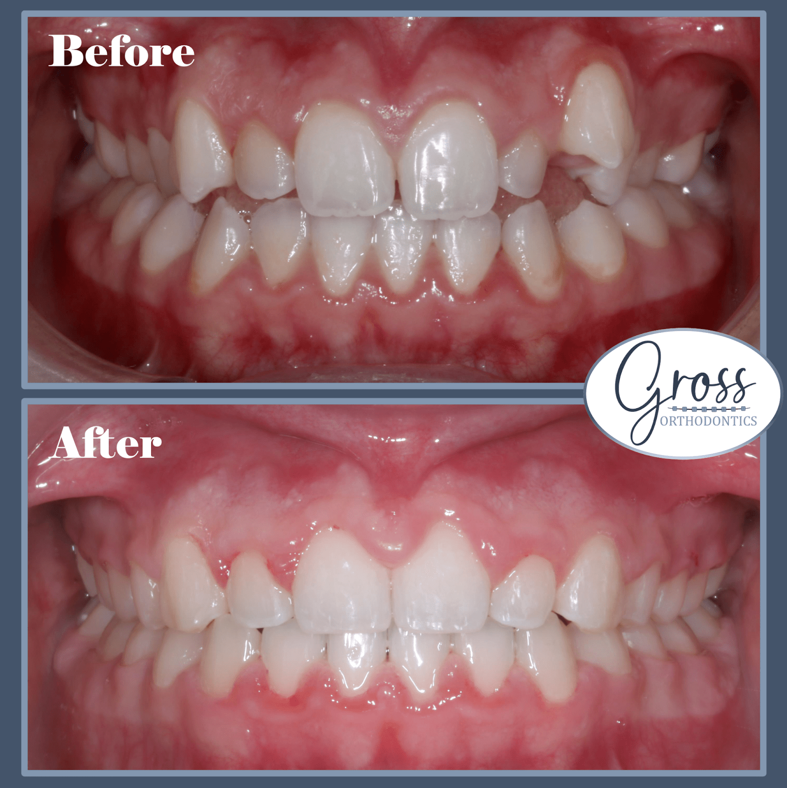 Before and after images of orthodontic treatment showing improved teeth alignment and smile aesthetics, featuring Gross Orthodontics logo.