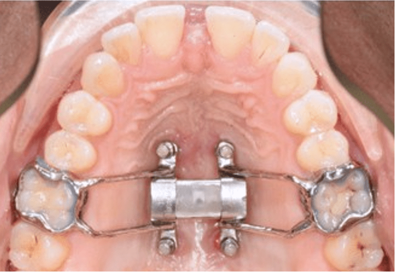 Palatal expander in a child's mouth, showcasing orthodontic treatment for airway health and dental alignment.
