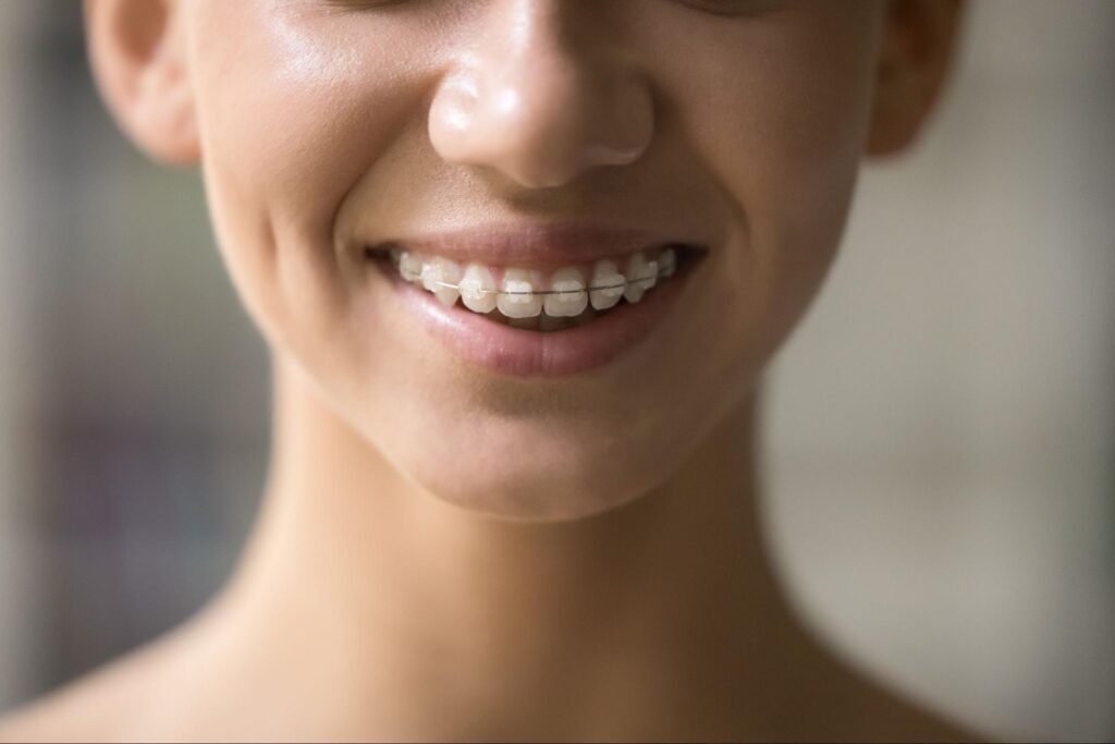 Smiling young person wearing clear aligners, showcasing discreet orthodontic treatment, relevant to discussions on clear aligners versus traditional braces in El Paso.