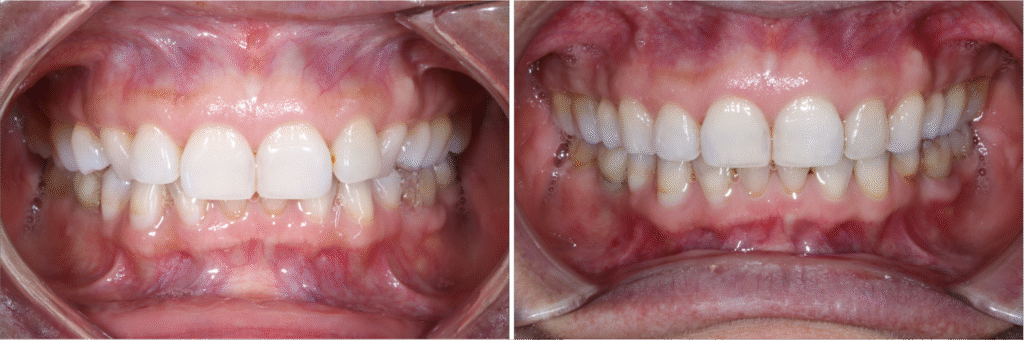 how clear aligner technology works  