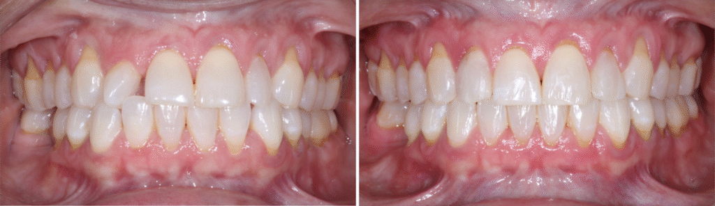 how clear aligner technology works  